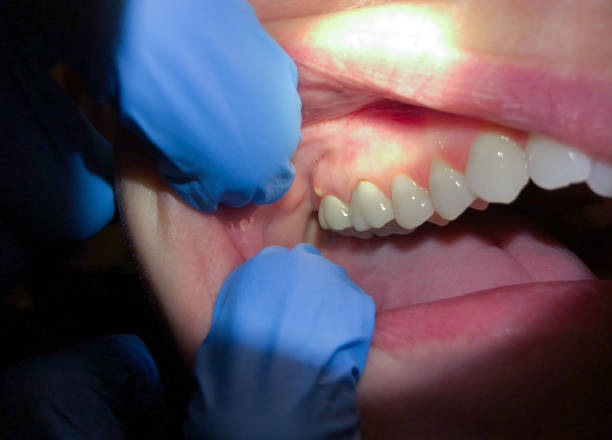 Best Emergency Treatment for Oral Infections in Smithfield, UT